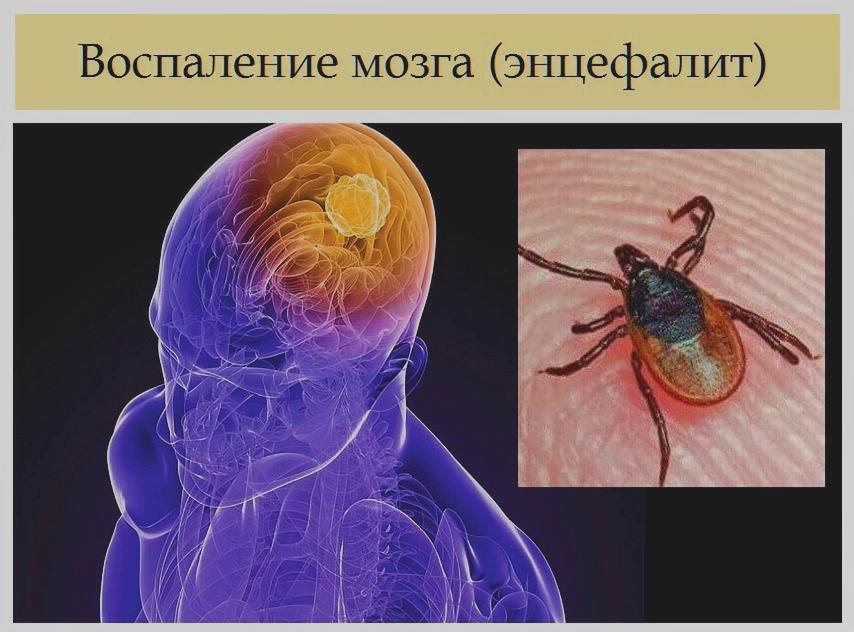 Клещевой энцефалит Клещевой энцефалит